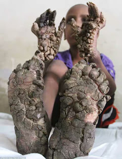 7Yrs Old Boy Hands And Feet Turning Into Trees